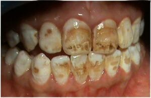 Hakora 2 Dirty teeth 2