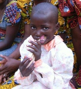 Cutar Noma 4 2005 09 Niger Noma 02