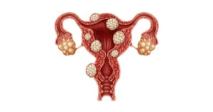 Fabrois 1 uterinefibroids opengraph