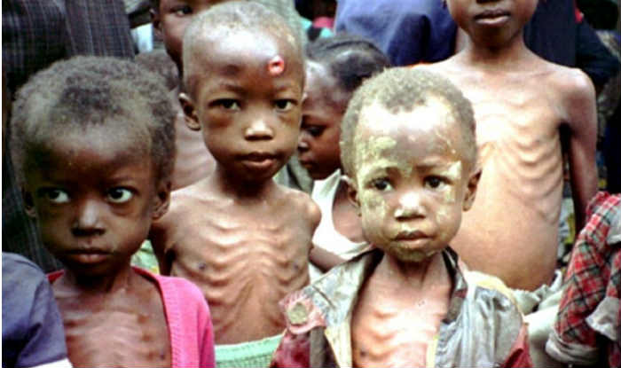 Severe Acute Malnutrition 1