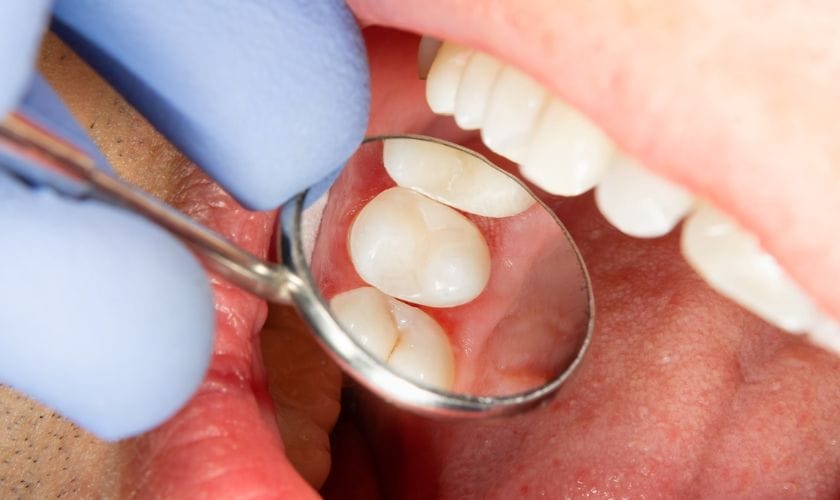 Ciwon hakori 1 Root Canals