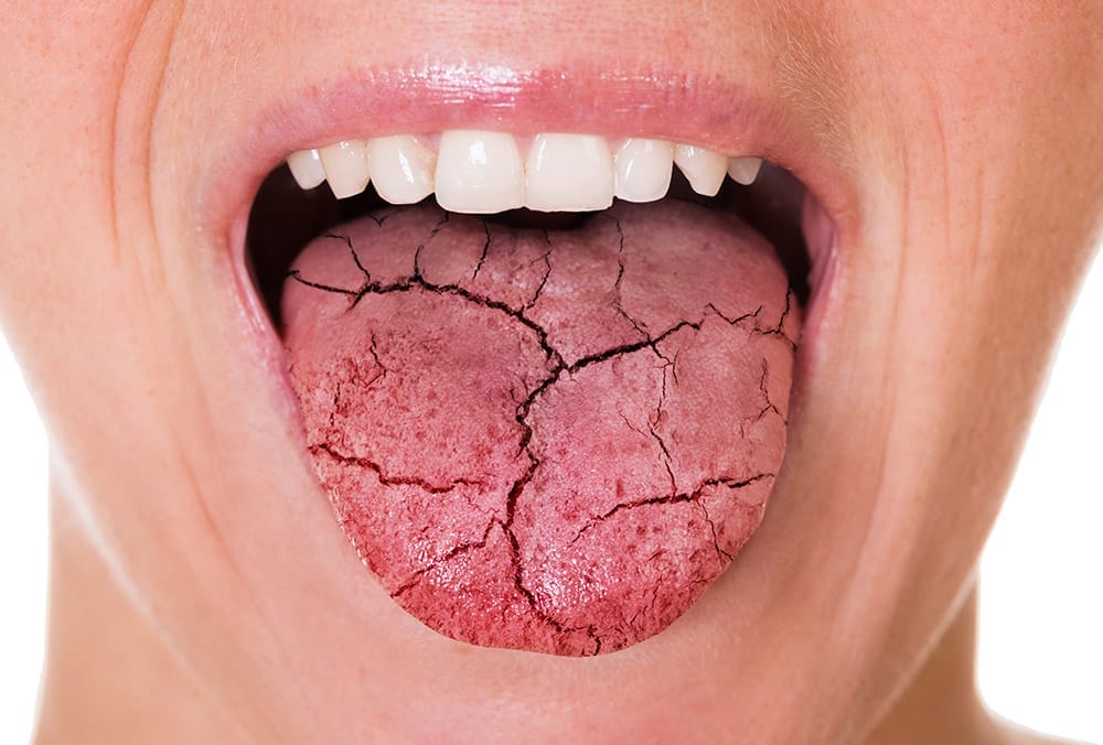 Dry Mouth and How to Treat It0