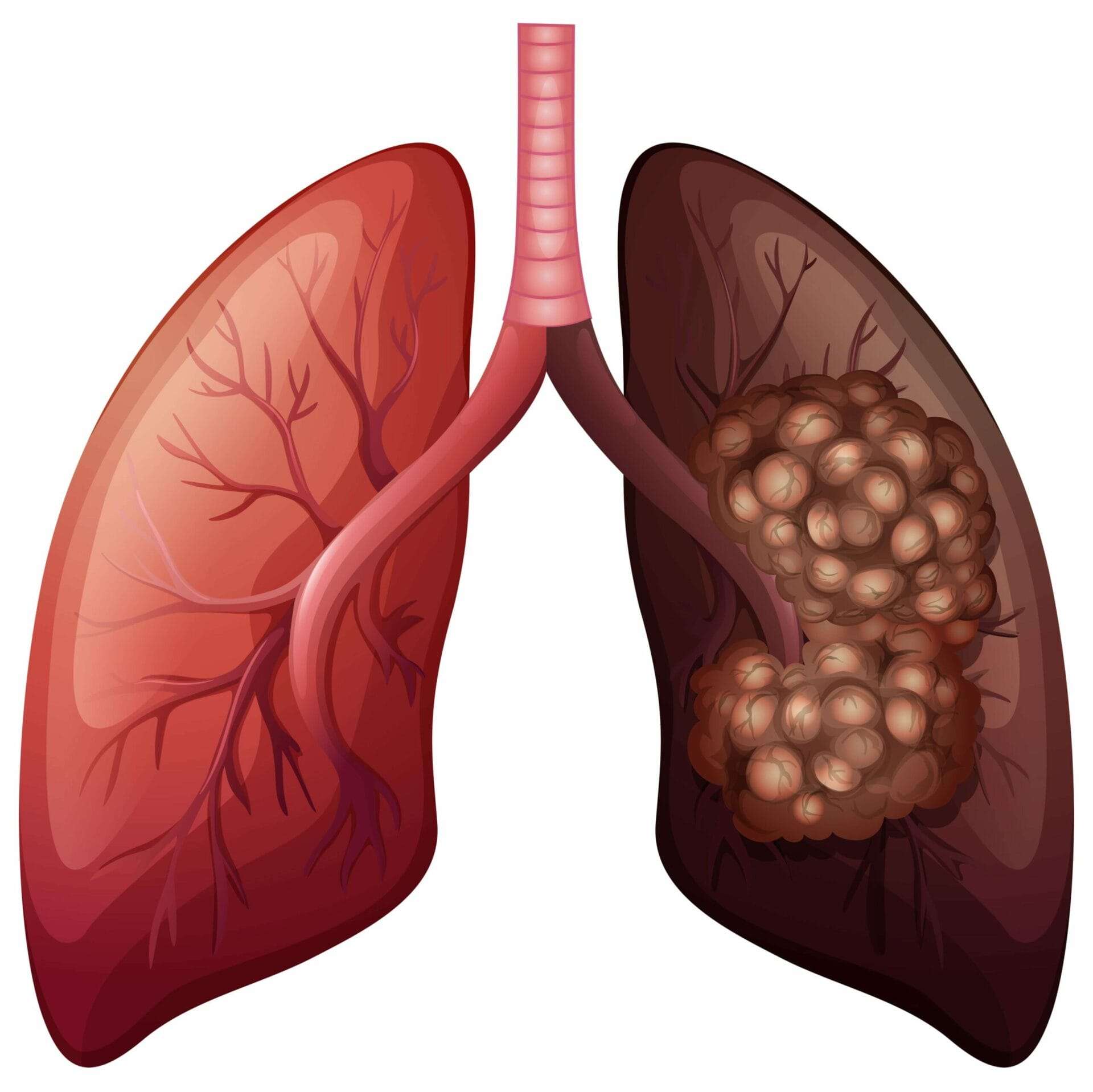 chicago personal injury lawyer what is early stage lung cancer scaled 1