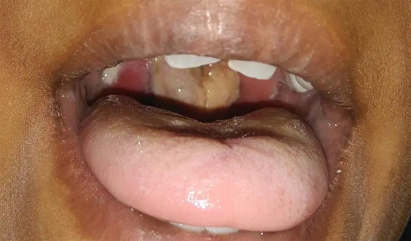 diphtheria0