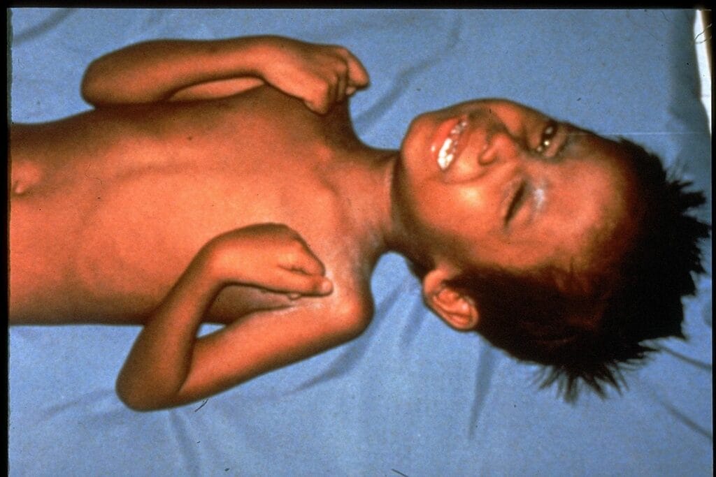 tetanus 1 1024x683 1