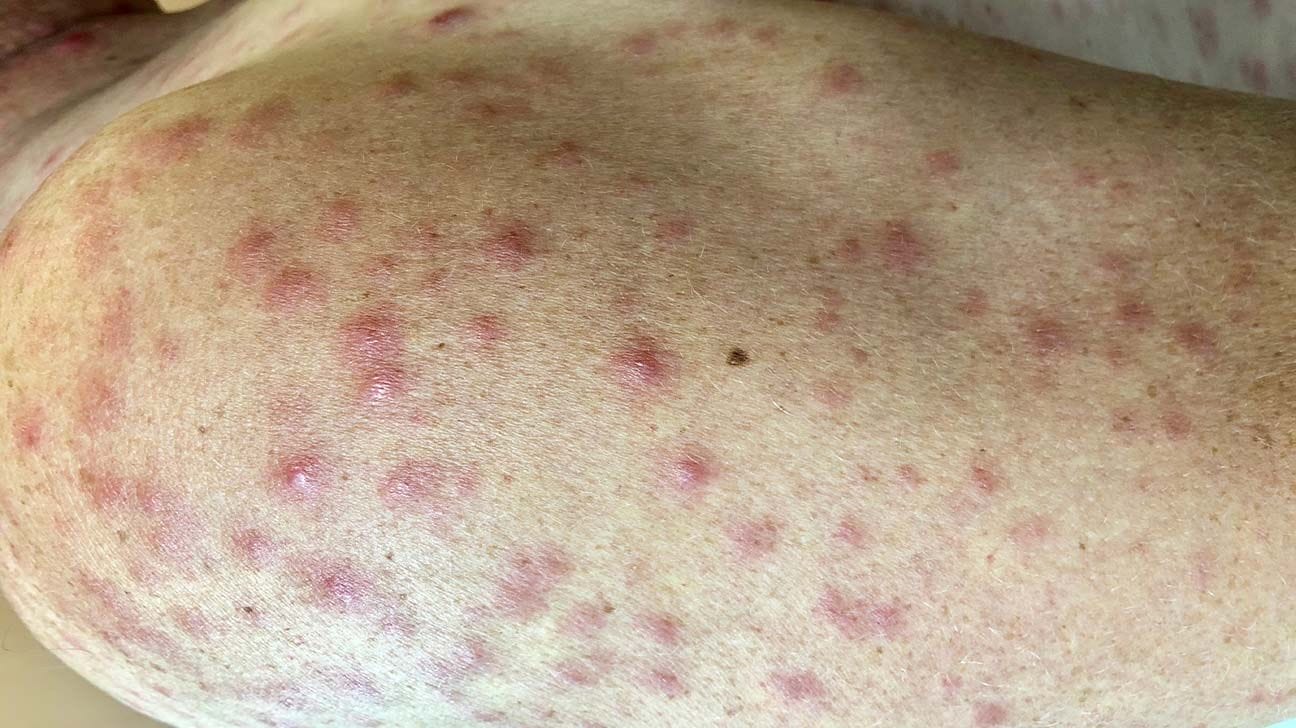 syphilis rash 1296x728 slide3