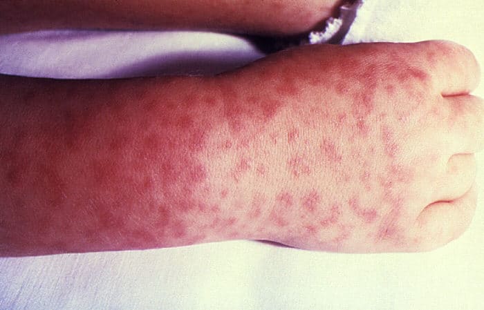 Rickettsial rash