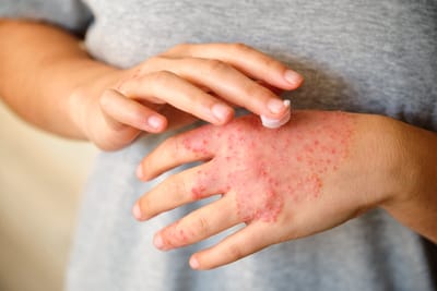 Eczema 1 Cutar eczema