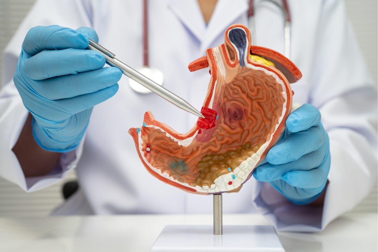 Ulcer 